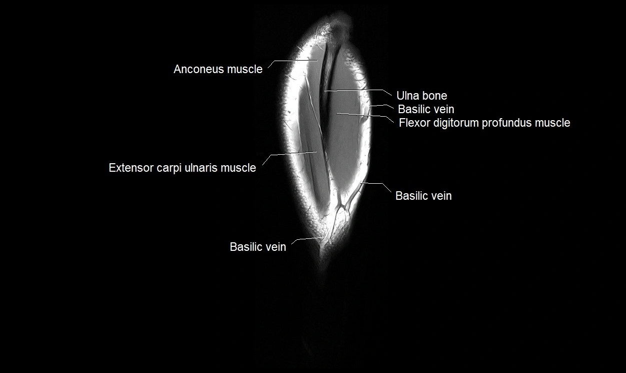 MRI 3T forearm coronal cross sectional anatomy image 26.webp